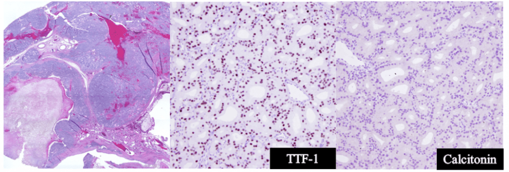 Magnified cellular stains of a dog's (Buddy's) thyroid tissues. The cellular stains reveals follicular thyroid carcinoma.
