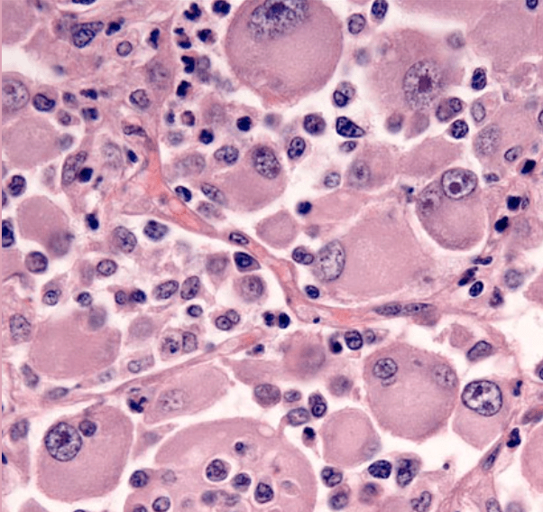 A dog's (Piper's) cellular stains. The stains accentuate the presence of histiocytes, that is, a specialized type of white blood cell.