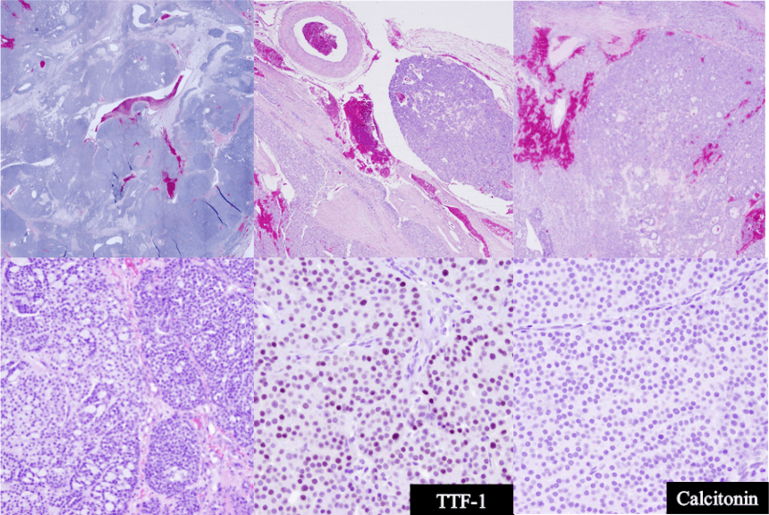 Highly magnified images of a dog's (Jax's) thyroid gland. These cellular stains indicate a 'mixed' cancer subtype.