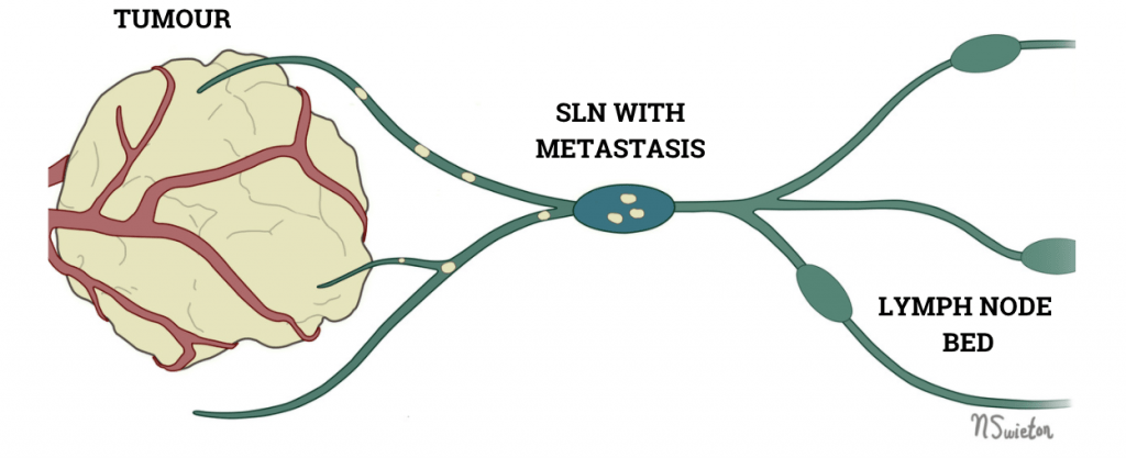 An illustration of a tumour in relation to  sentinel lymph nodes. In the image, it can be seen that tumours spread, or metastasize, to local lymph nodes. The first lymph node that a tumour drains into is known as the sentinel lymph node, shown in the centre of this image.