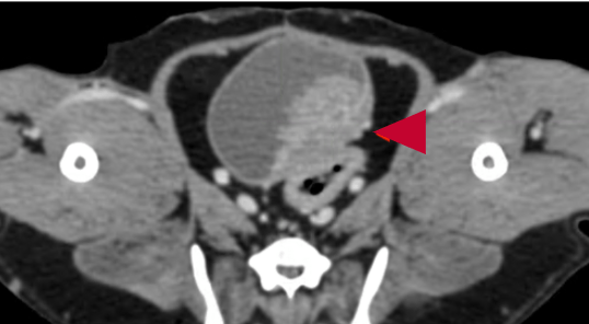 Black and white CT image of a dog's (Jasmin's) abdomen from a transverse view. A tumour can be seen within the wall of the bladder.