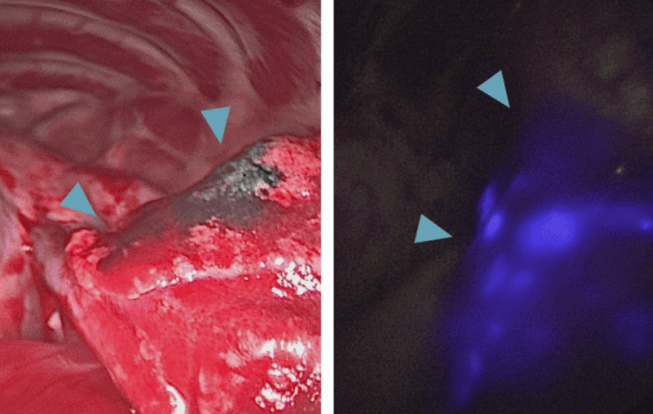 The image on the left shows Monty's tumour and metastasized local lymph nodes. The image on the right shows Monty's tumour and metastasized local lymph nodes glowing in the dark by the use of a special dye called indocyanine green and a near-infrared fluorescence camera. 