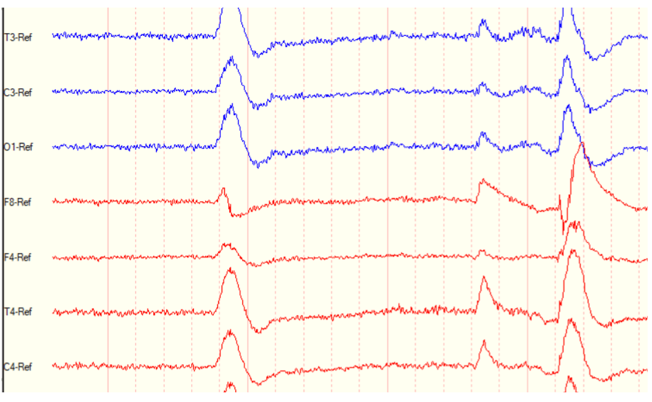 Image of an EEG with blue and red squiggly lines