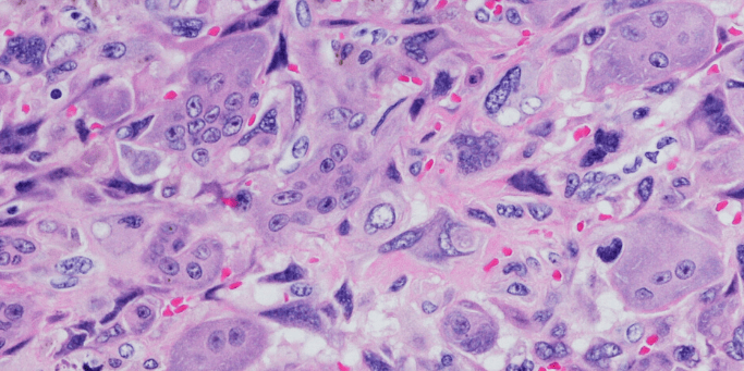 Image of a hematoxylin and eosin stain of cancer cells. There is a series of pink and purple shapes. 